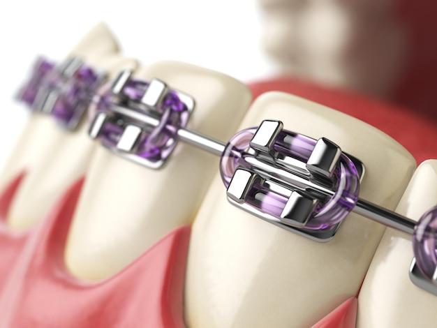 7 Great Reasons To Pick Purple Braces For A Beautiful Smile 
